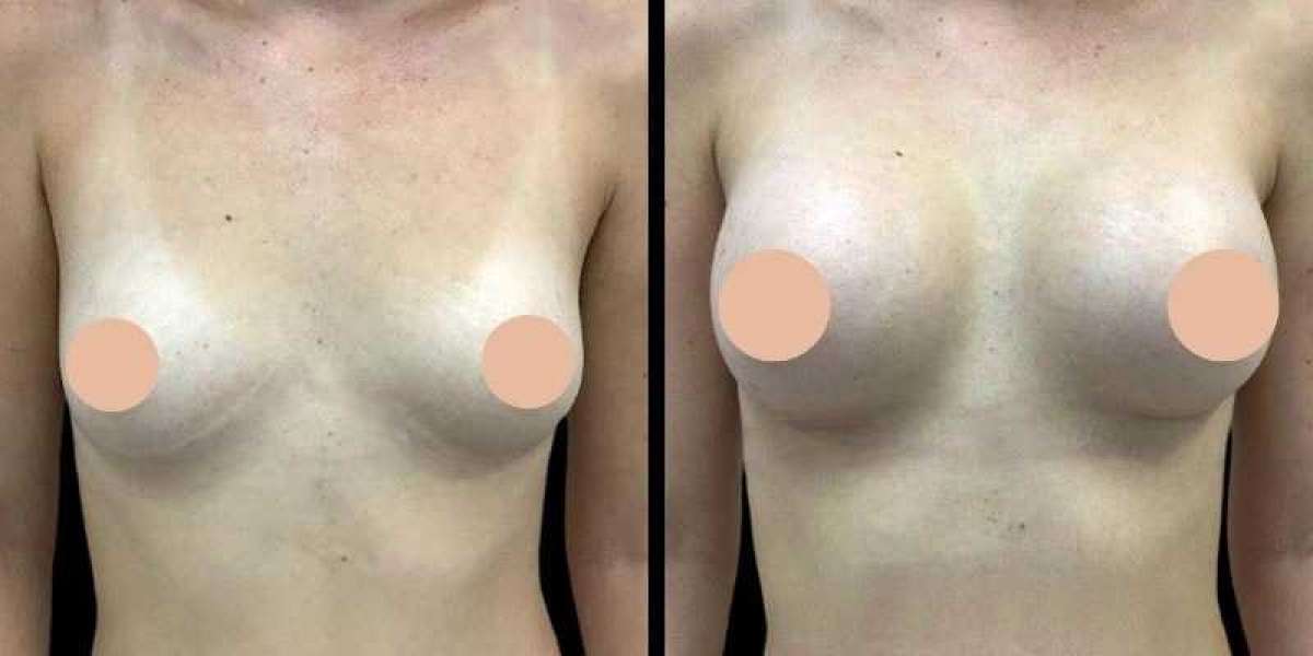 Breast Augmentation Recovery Tips: Best Breast Augmentation Surgeons in Dubai