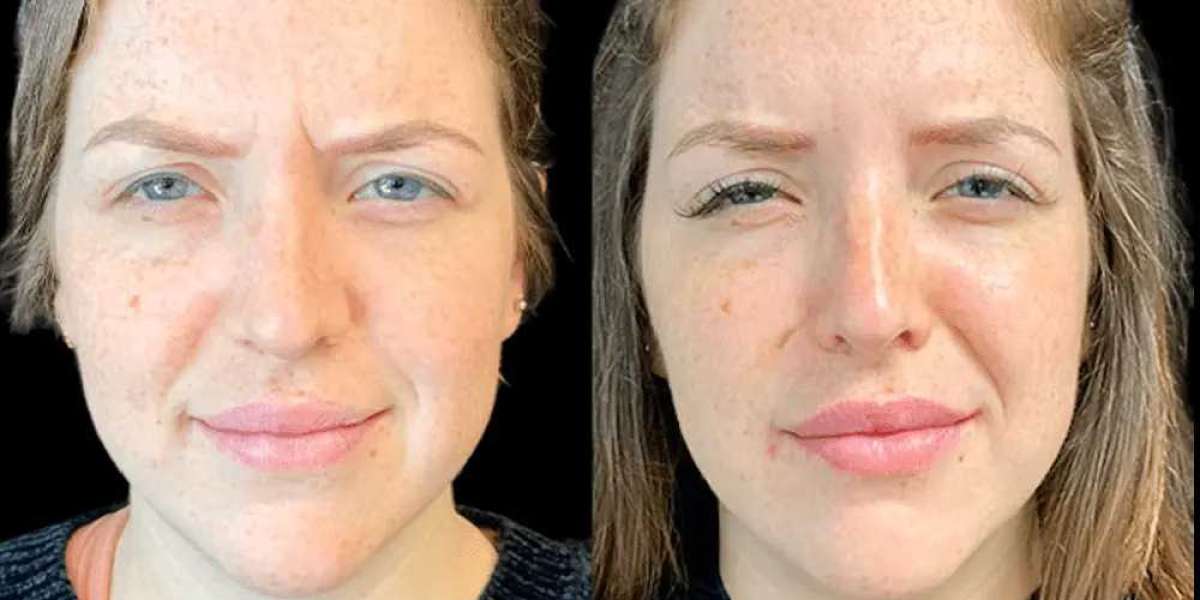 Botox Treatments in Dubai: Preparing for Your Consultation