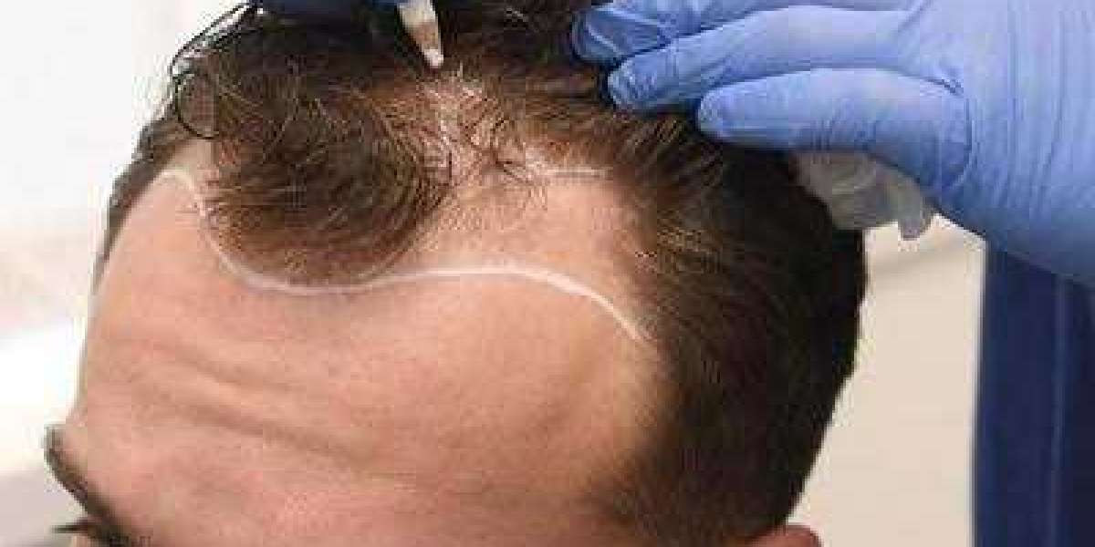 Hair Transplant in Dubai: Designing Precise Graft Placement