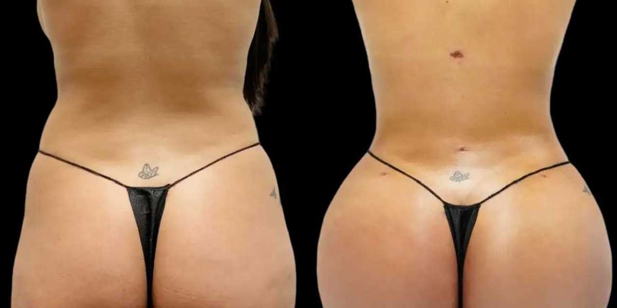 Best fat transfer Surgeons in dubai: Fat Transfer for Facial Asymmetry