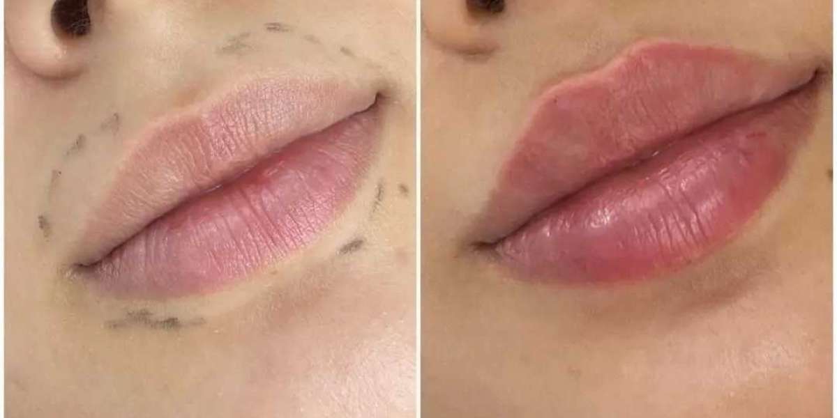 Juvederm Youthful Appearance Best Aesthetic Clinic in Dubai