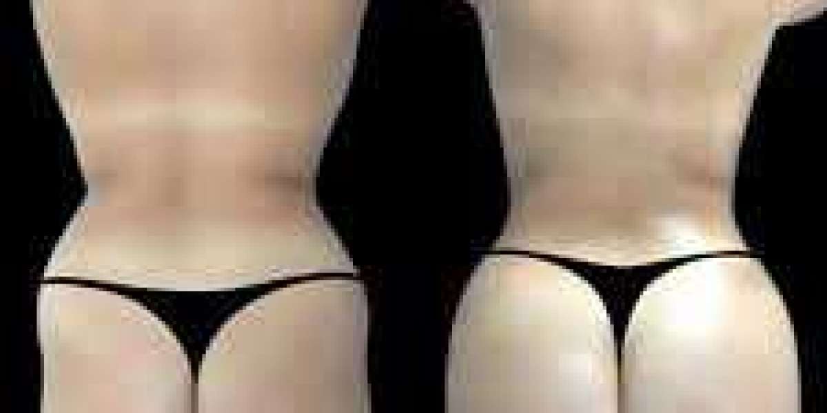 What to Ask About Aftercare from the Best butt fat transfer Surgeons in dubai