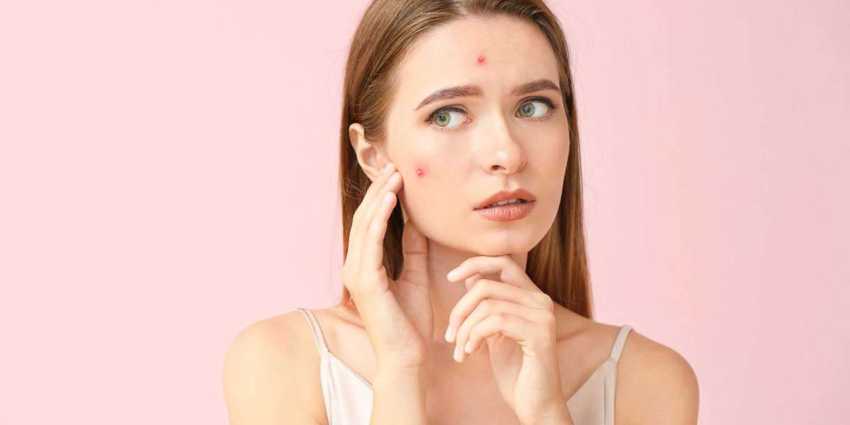Acne Treatment in Dubai: How to Manage Mild, Moderate, and Severe Acne