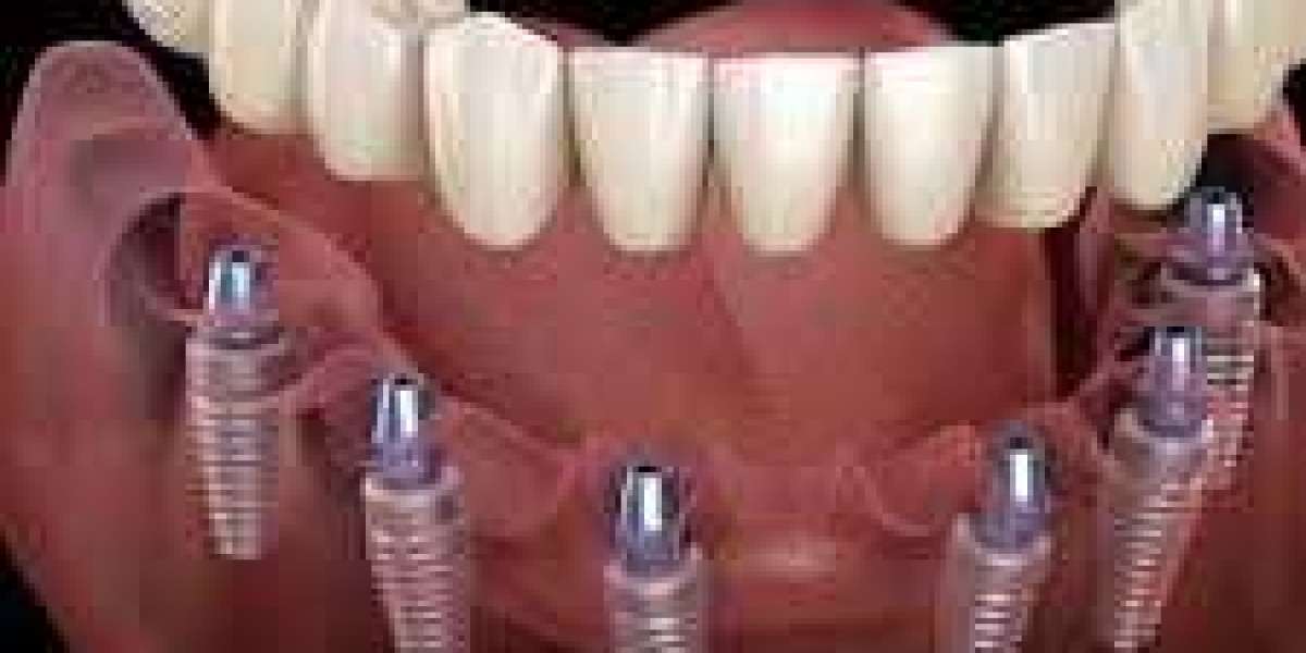 Dental Implants for Front Teeth: Restoring Your Smile Naturally