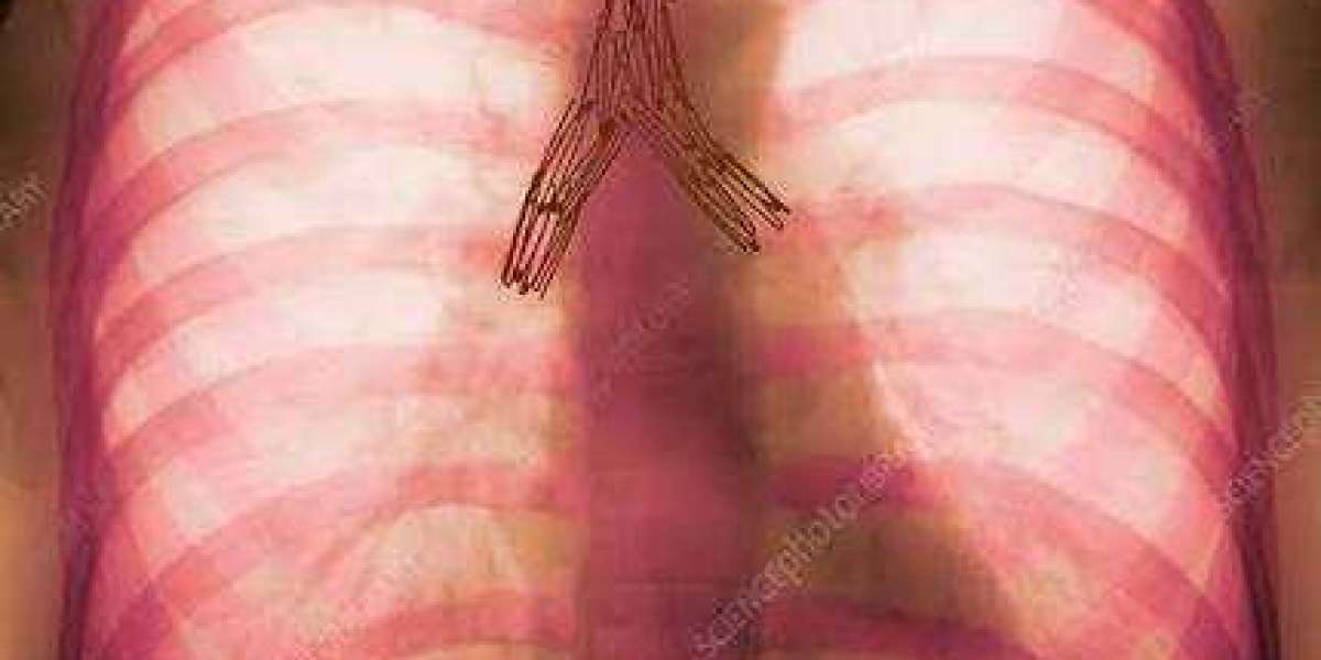Airway Stents Gain Clinical Relevance as Minimally Invasive Treatments Advance